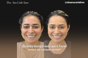 Quanto tempo leva para fazer lentes de contato dental?
