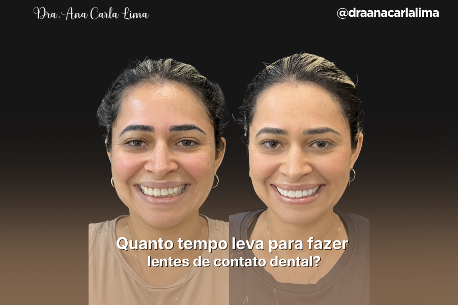 Quanto tempo leva para fazer lentes de contato dental?
