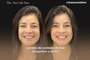 Lentes de contato dental desgastam o dente?