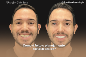 Como é feito o planejamento digital do sorriso?