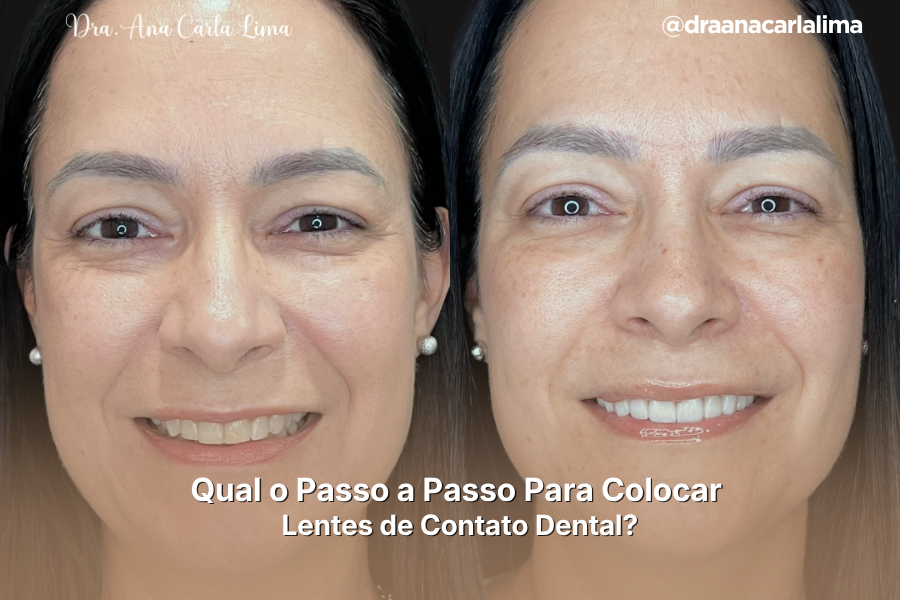 Lentes de Contato Dental